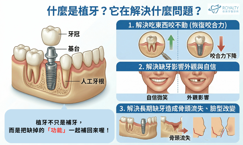 什麼是植牙?它在解決什麼問題?示意圖