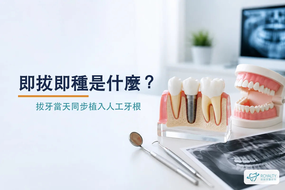 即拔即種人工植體與天然牙齒的齒槽骨剖面模型
