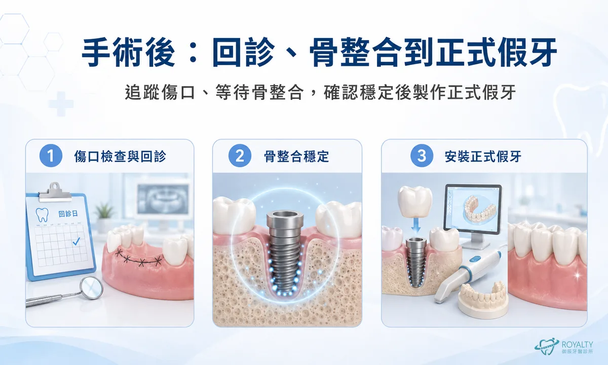 即拔即種手術後三個步驟：傷口檢查與回診、骨整合穩定、安裝正式假牙