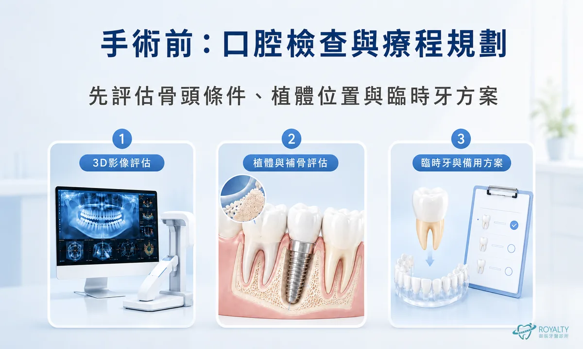 即拔即種手術前三個步驟：3D影像評估、植體與補骨評估、臨時牙與備用方案