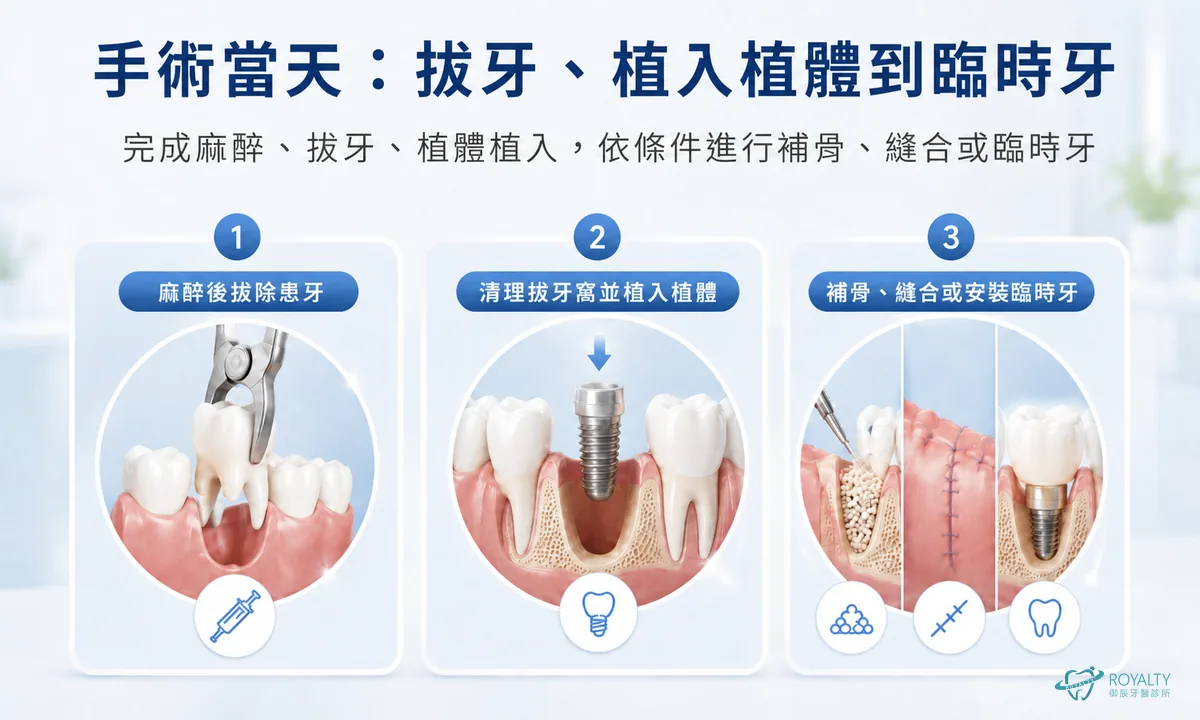 即拔即種手術當天三個步驟：麻醉後拔除患牙、清理拔牙窩並植入植體、補骨縫合或安裝臨時牙