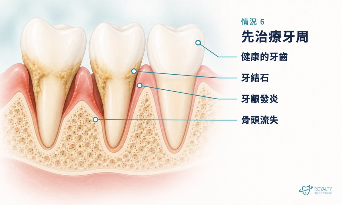 牙周病剖面示意圖:牙結石、牙齦發炎與骨頭流失,對照健康的牙齒