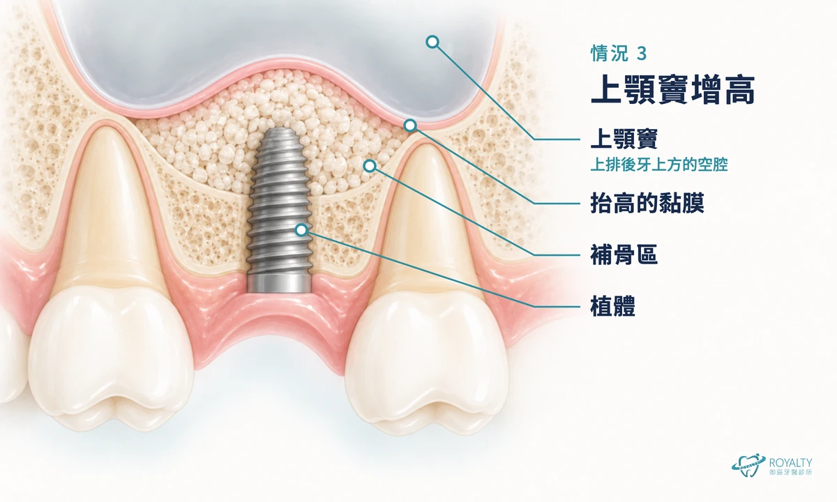 上顎竇增高術剖面示意圖:上顎竇底部黏膜抬高,下方補骨後植入植體